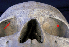 Cribra orbitalia