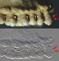Hipoplasia del esmalte dental